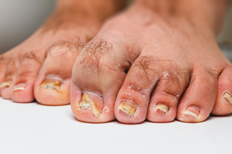 Kalk- en schimmel nagels