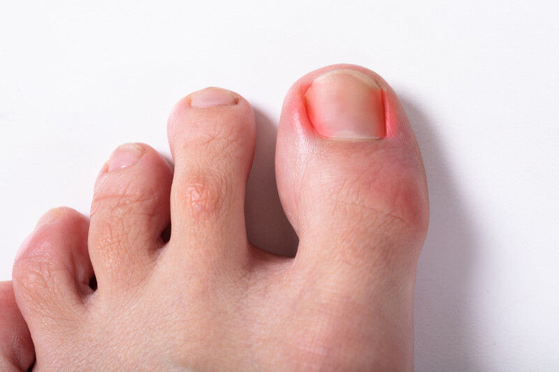 Ingegroeide teennagels